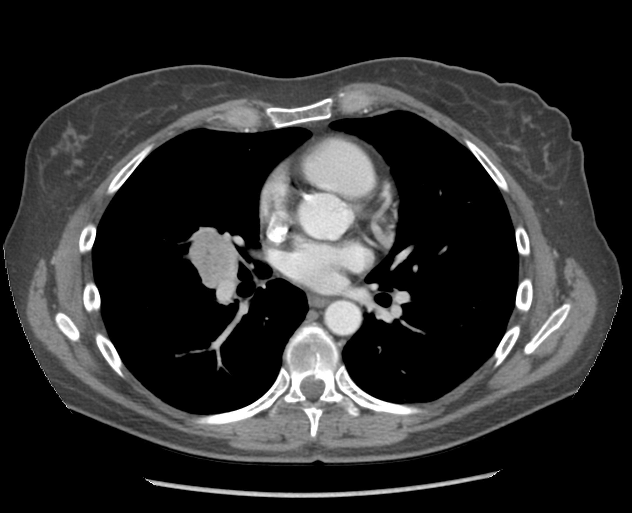 CT-Tumor.jpg