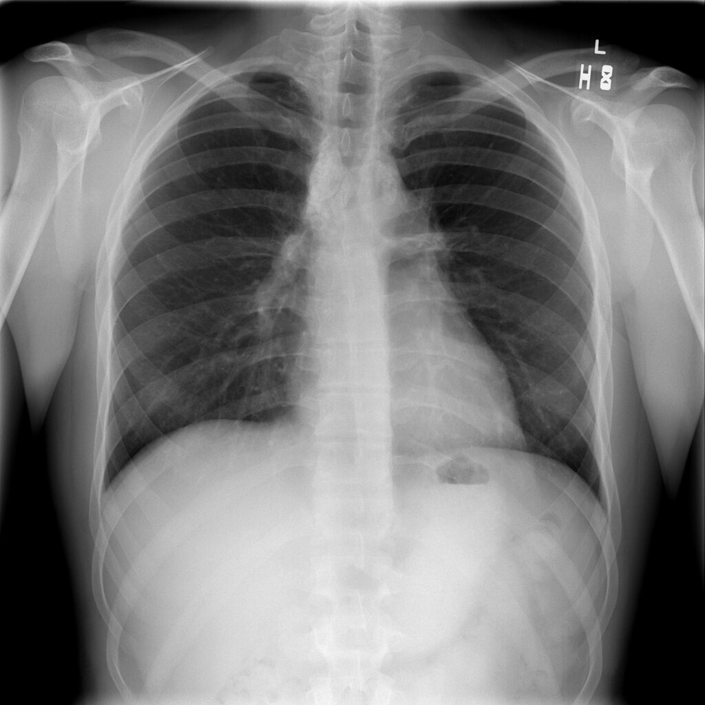 Lymphadenopathy2.jpg