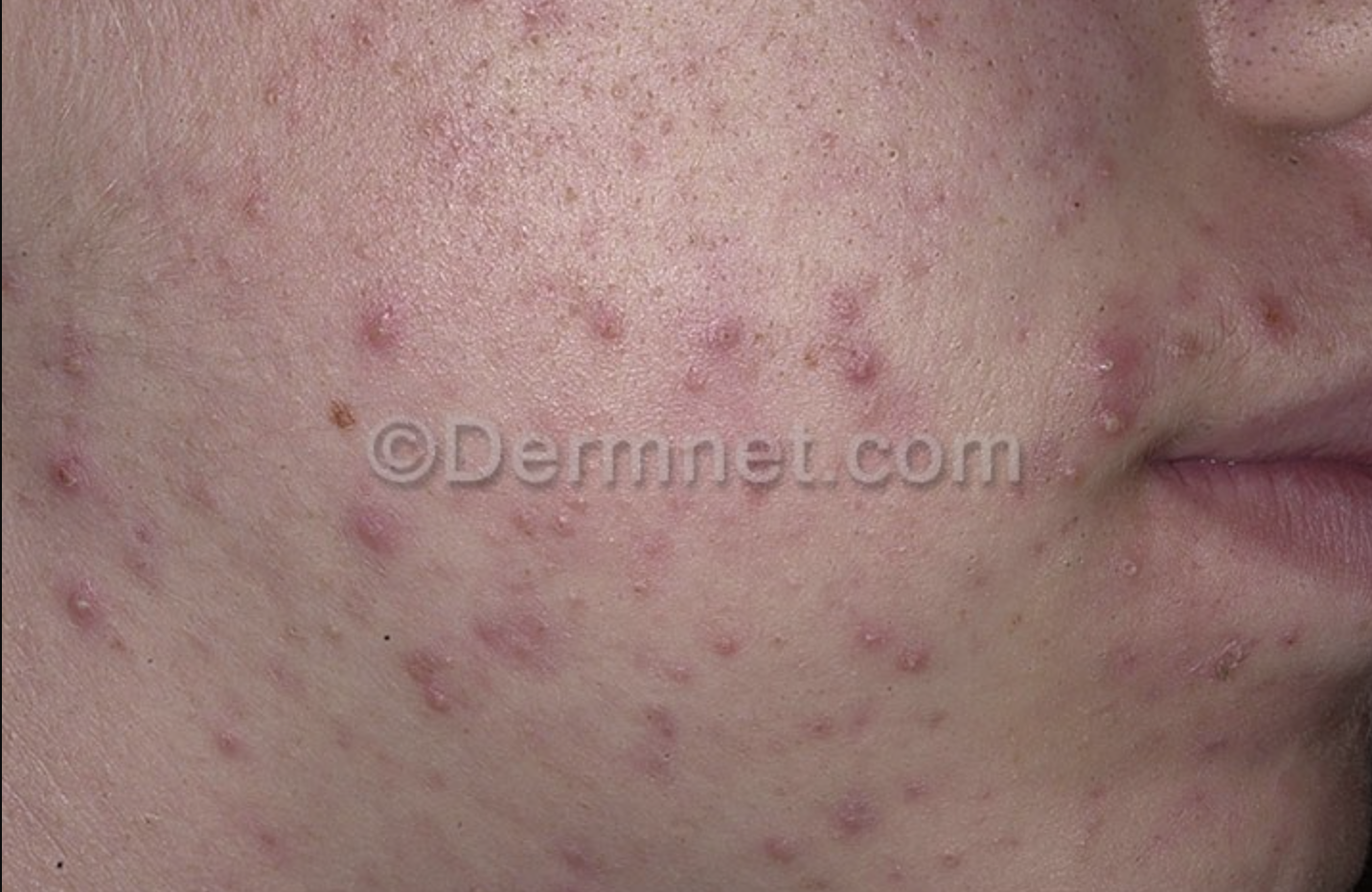 acne.png
